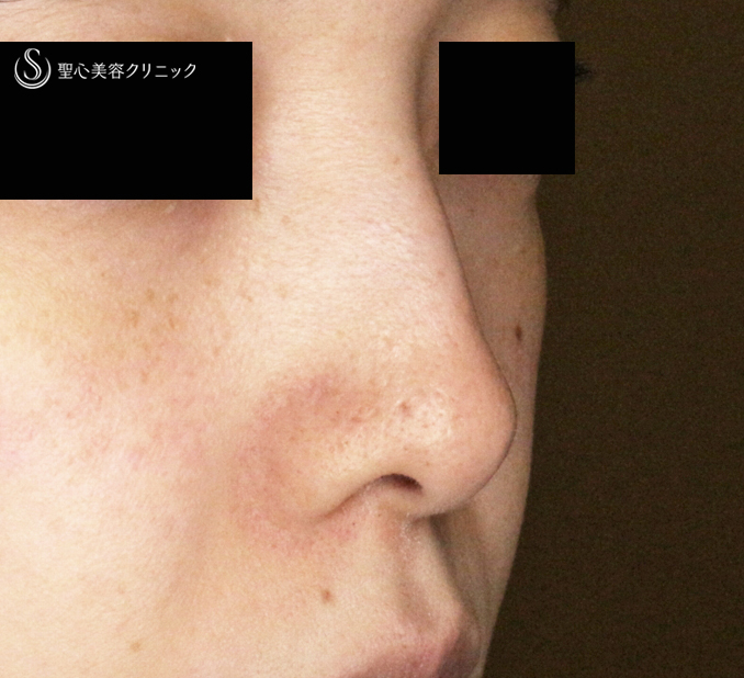 鼻尖形成（耳介軟骨移植）＋鼻尖縮小_Before