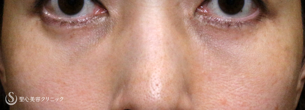 下眼瞼切開術/下眼瞼除皺術/ハムラ法_After