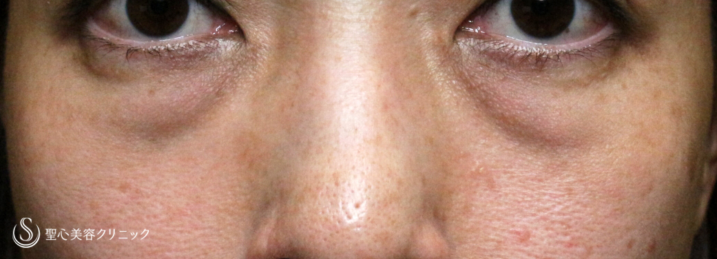 下眼瞼切開術/下眼瞼除皺術/ハムラ法_Before