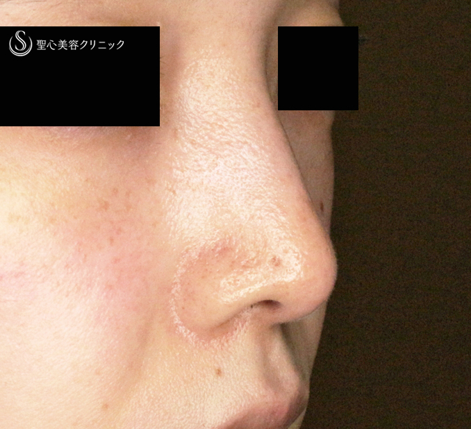 鼻尖形成（耳介軟骨移植）＋ 鼻尖縮小_After