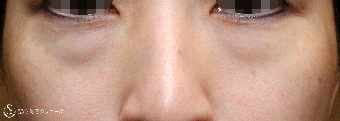目の下の脂肪取り（経結膜下脱脂法）＋プレミアムPRP皮膚再生療法_Before