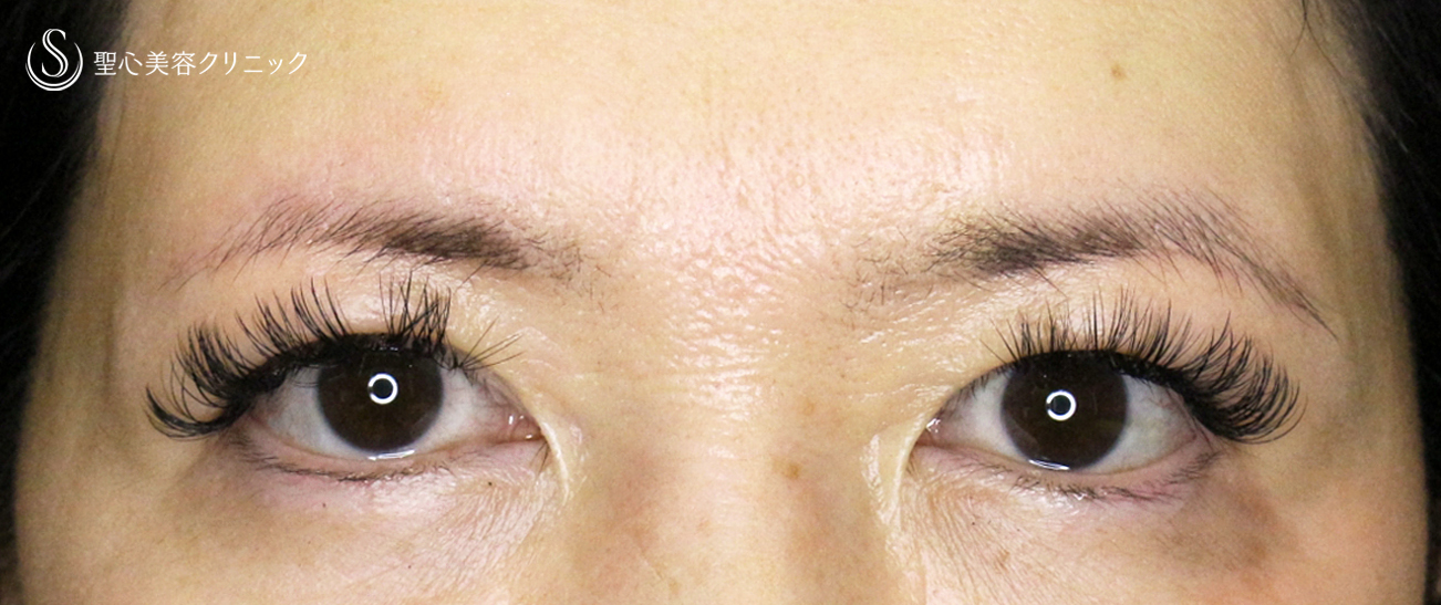 眉下リフト+α（札幌院独自メニュー）_After