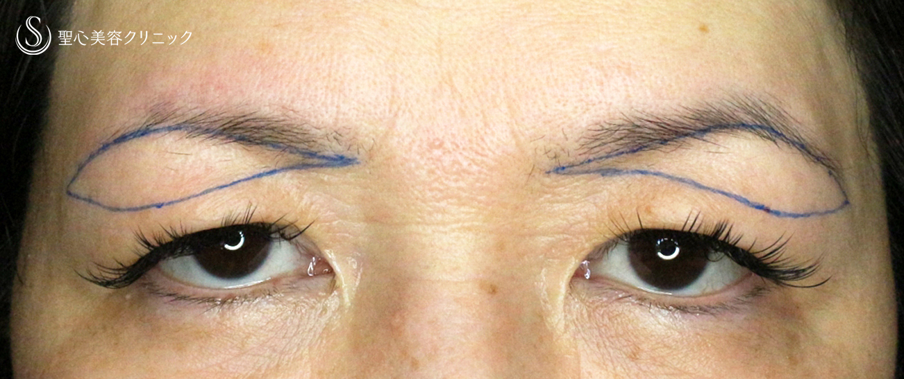 眉下リフト+α（札幌院独自メニュー）_Before