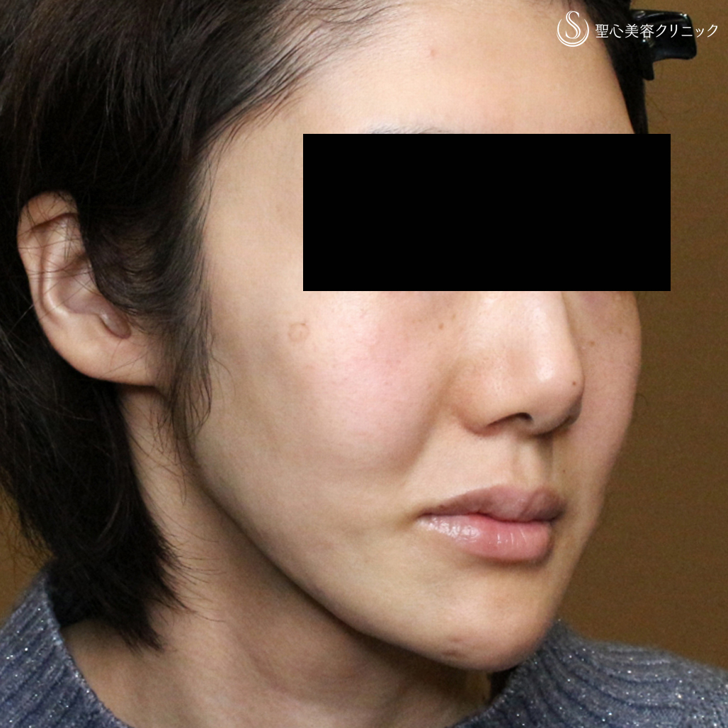 プレミアムPRP皮膚再生療法_After