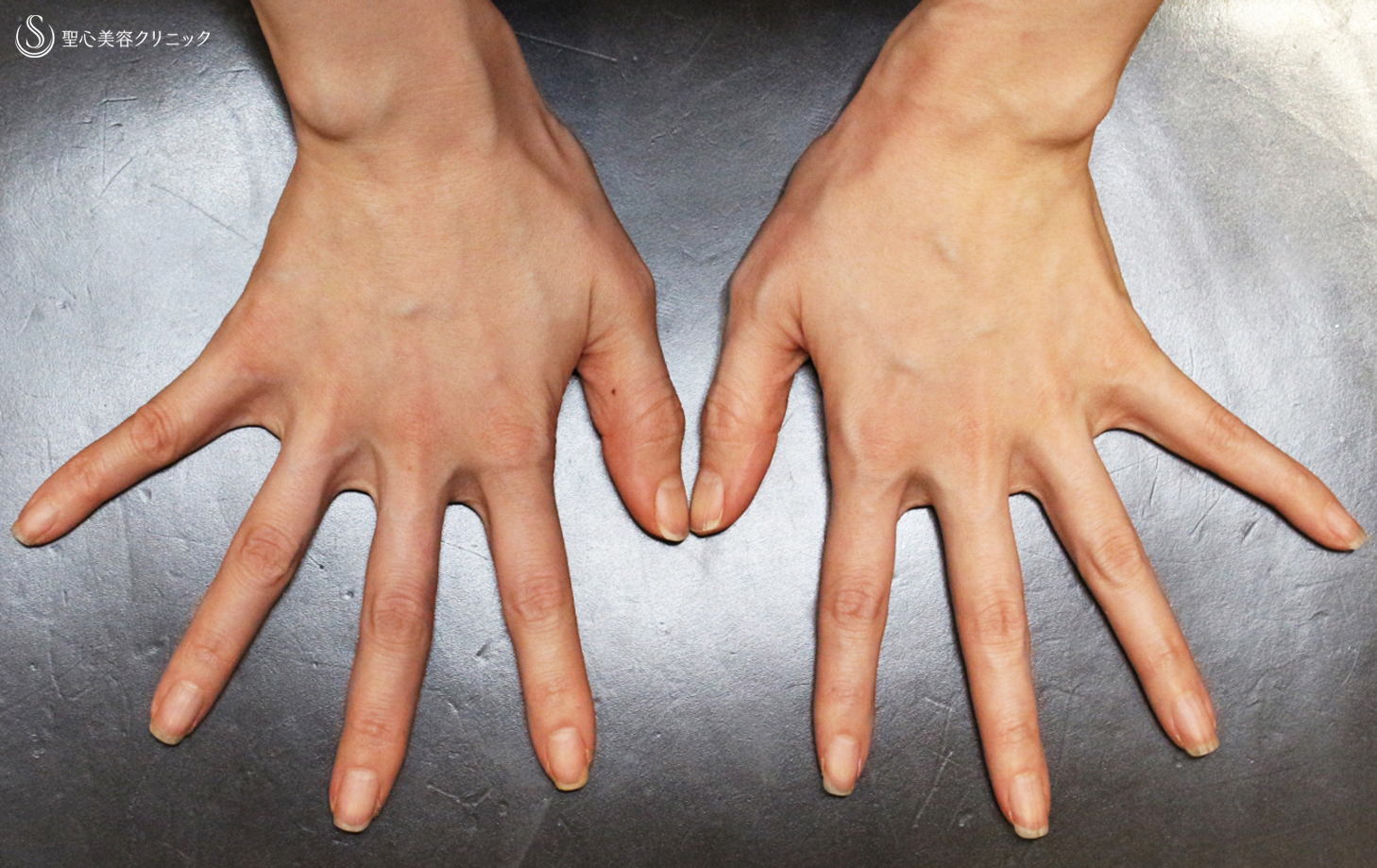 プレミアムPRP皮膚再生療法_After