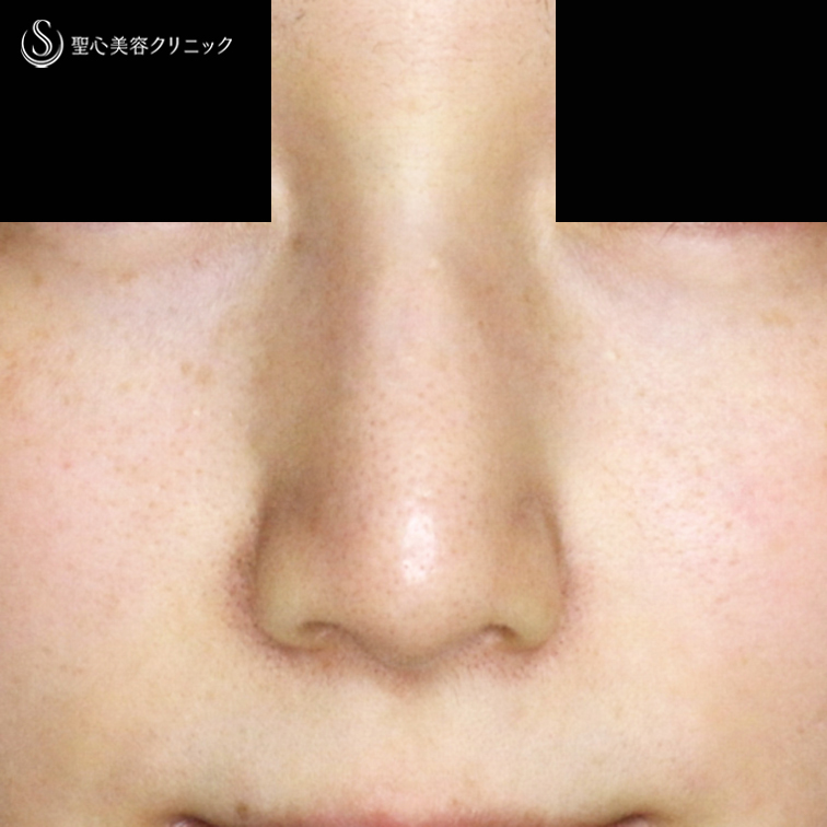 小鼻縮小術+α法（札幌院独自メニュー）＋鼻尖縮小術+α法（札幌院独自メニュー）_After