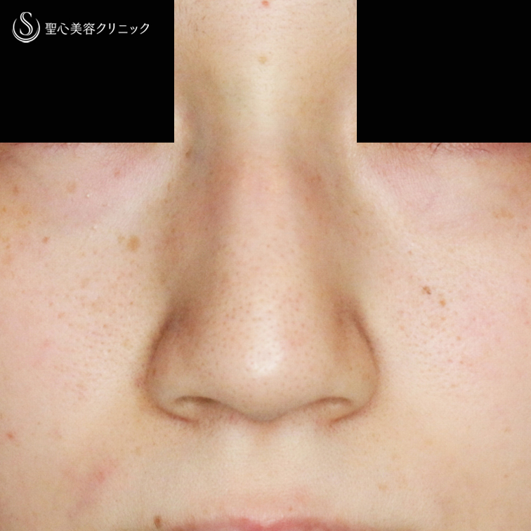 小鼻縮小術+α法（札幌院独自メニュー）＋鼻尖縮小術+α法（札幌院独自メニュー）_Before