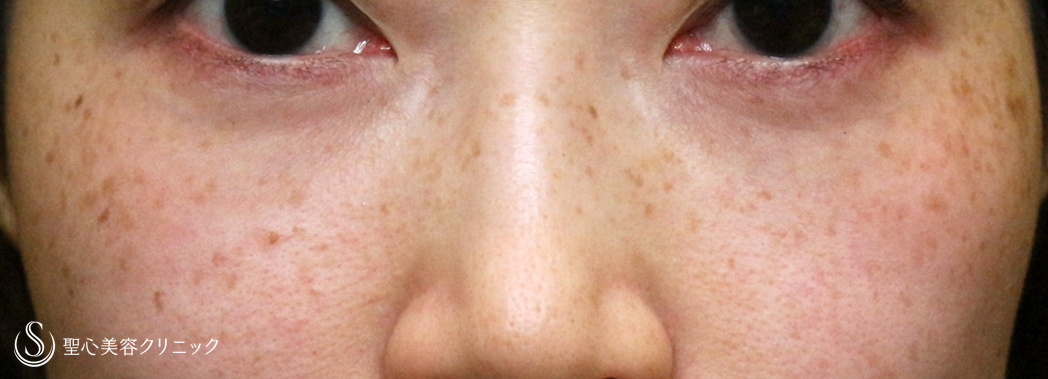 目の下の脂肪取り（経結膜下脱脂法）_After