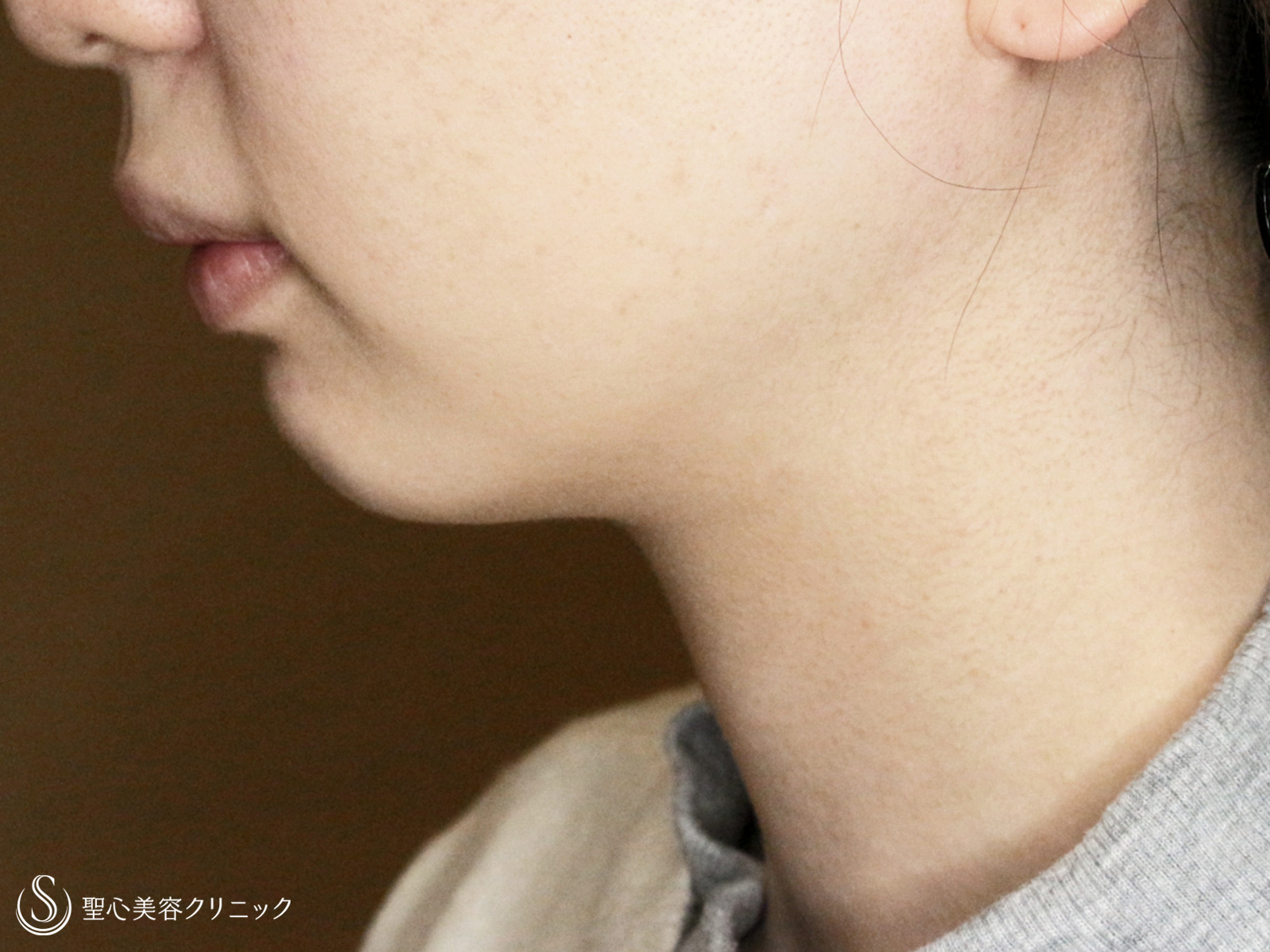 ベイザーリポ2.2脂肪吸引_After