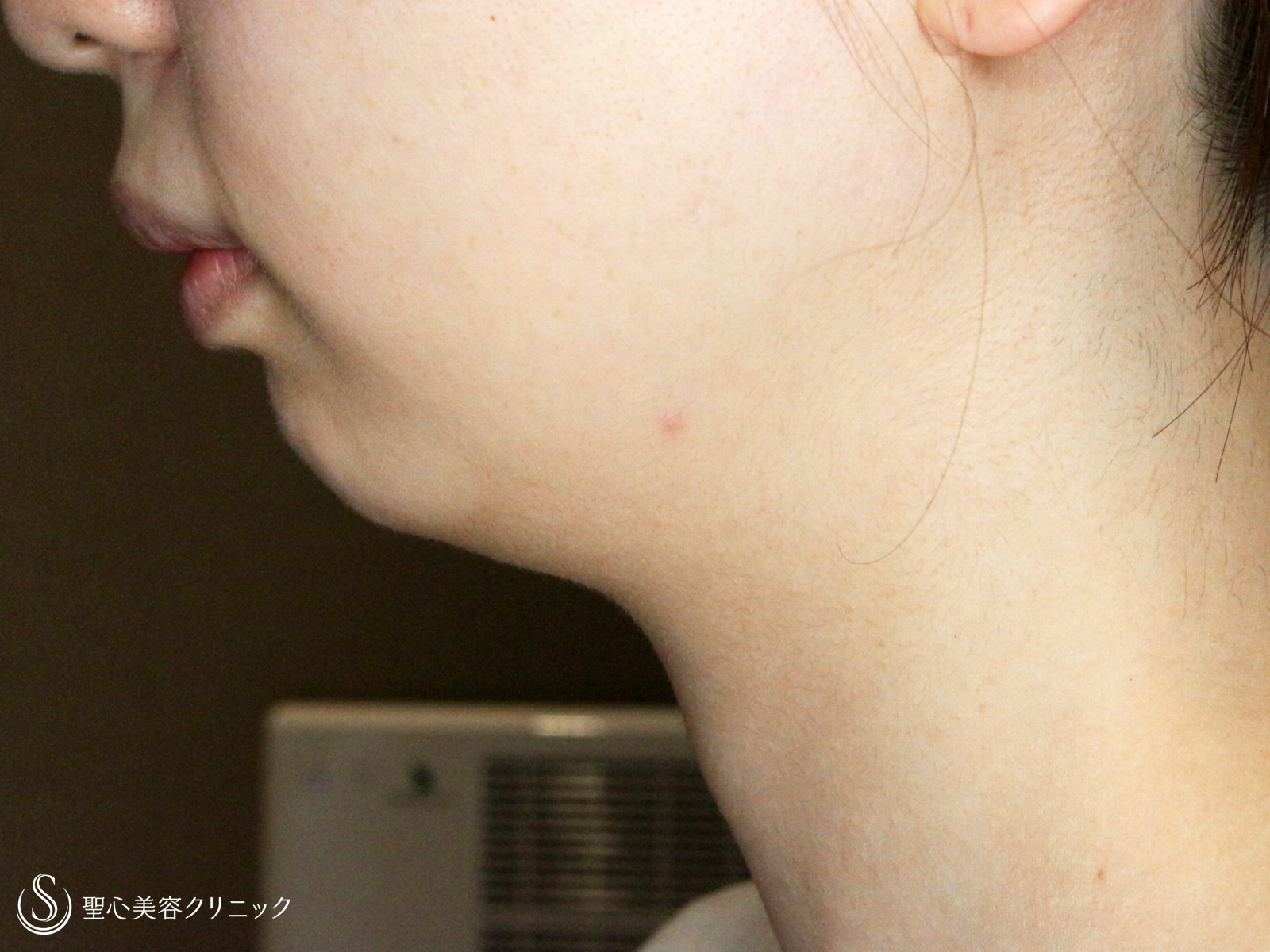 ベイザーリポ2.2脂肪吸引_Before