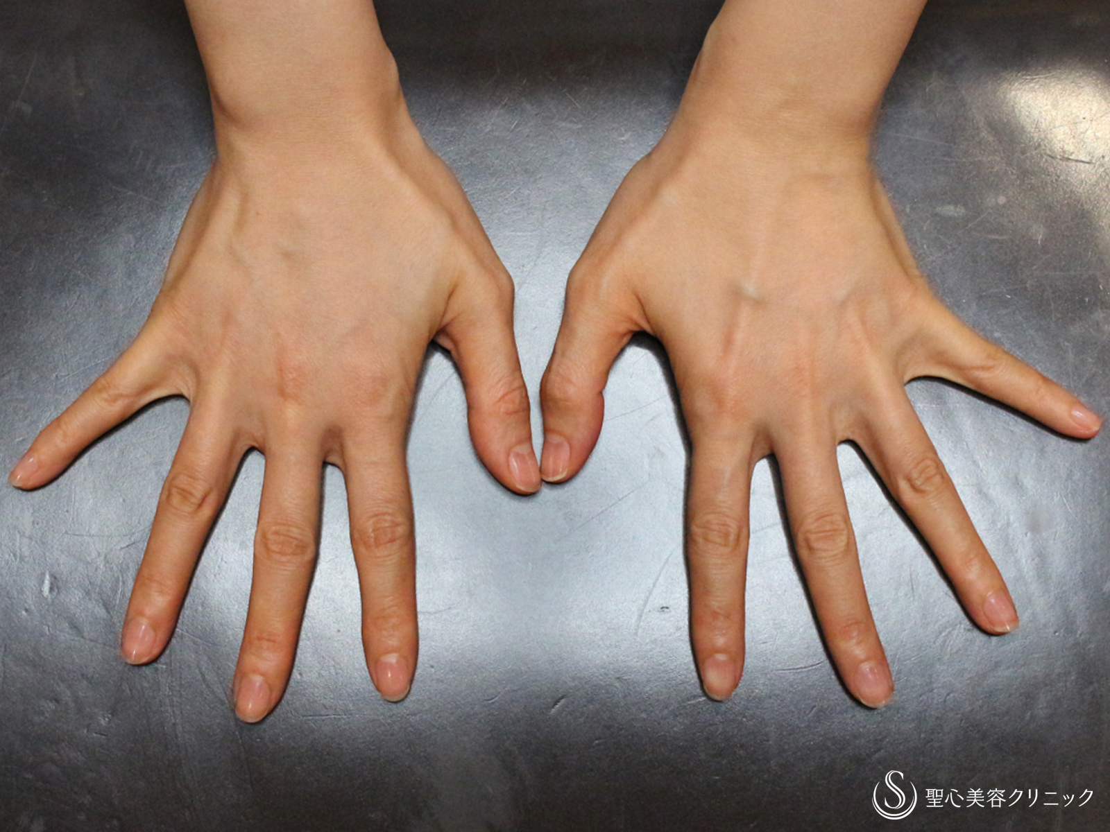 プレミアムPRP皮膚再生療法_After