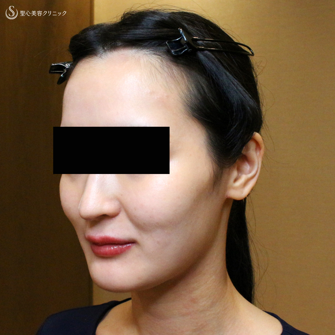 プレミアムPRP皮膚再生療法_Before