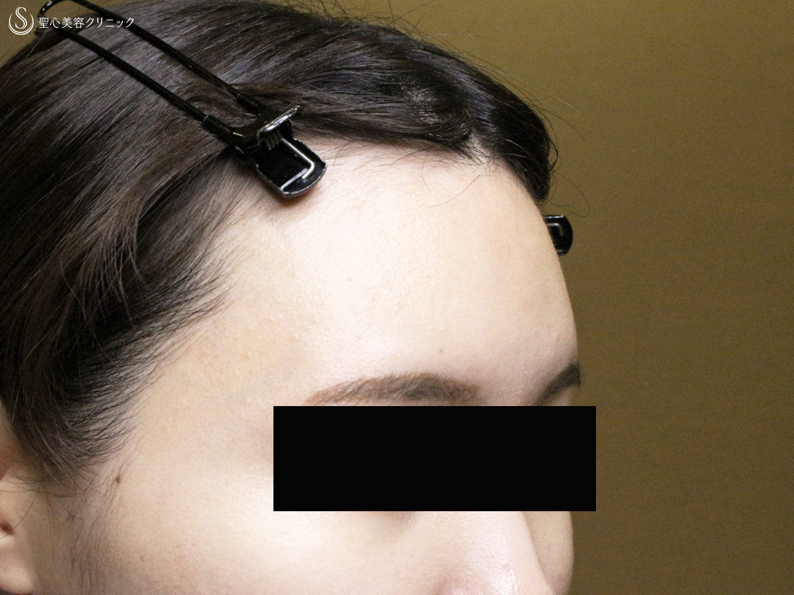 プレミアムPRP皮膚再生療法_After