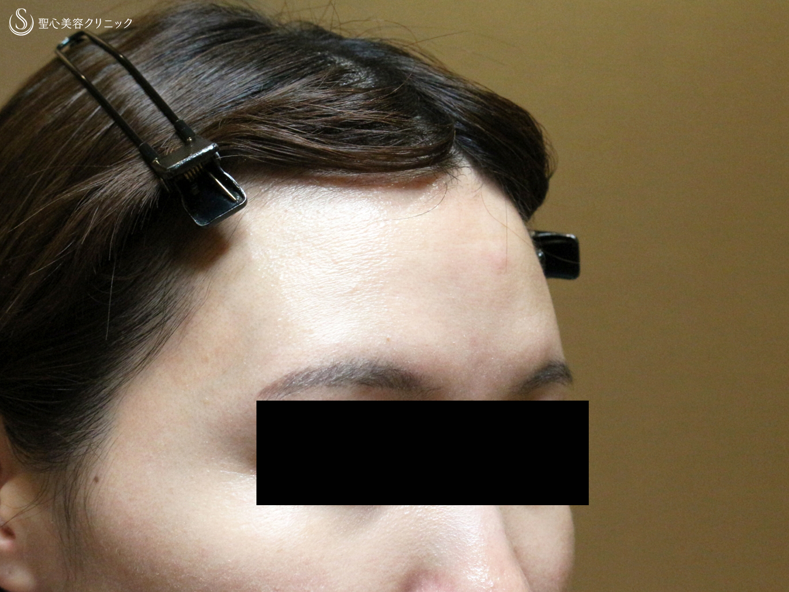 プレミアムPRP皮膚再生療法_Before