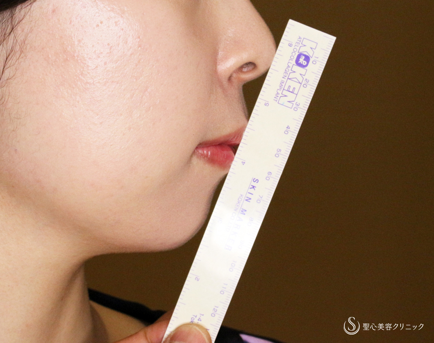  ヒアルロン酸注入（あご）＋プレミアムPRP皮膚再生療法＋ボトックス注入_After