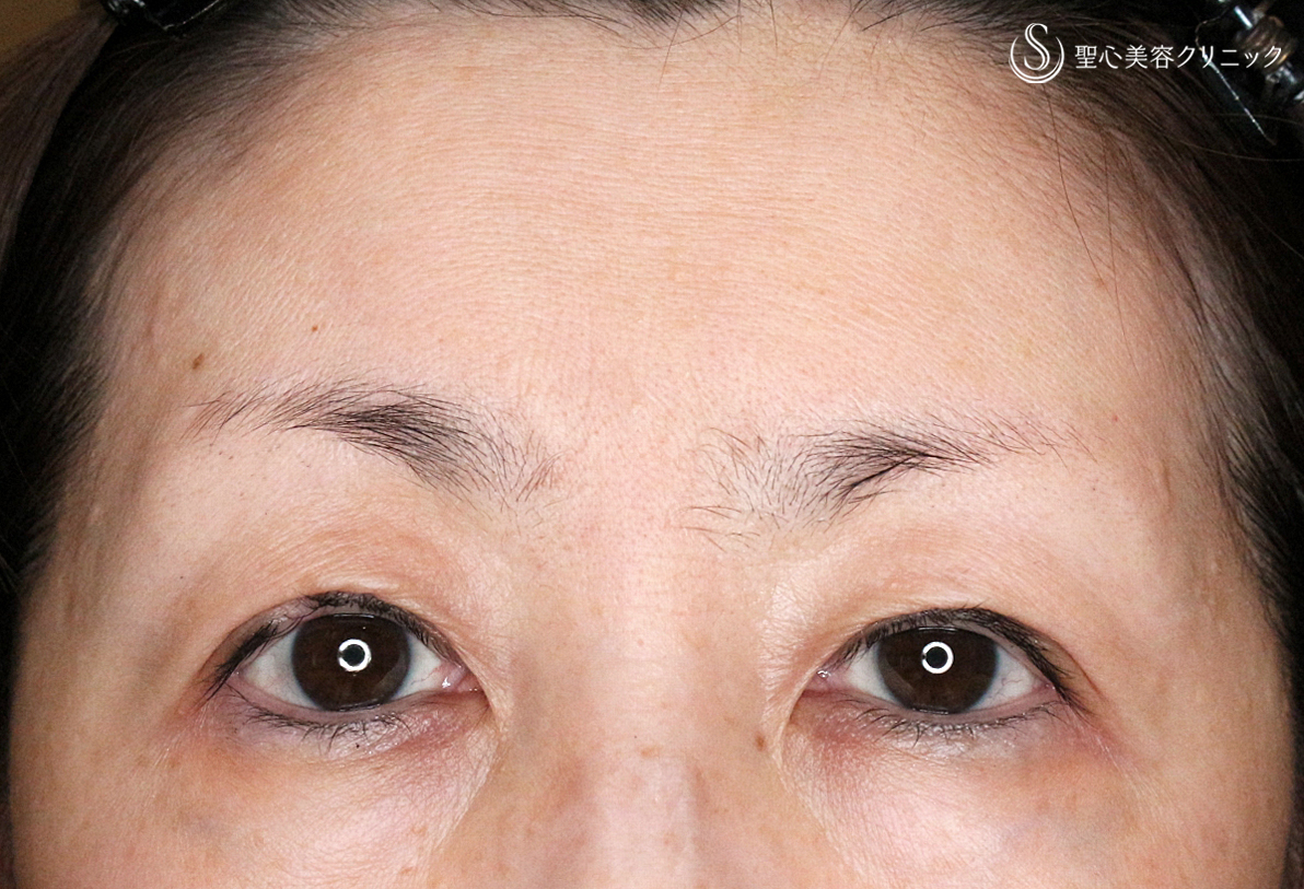 切らない眼瞼下垂+α法（札幌院独自メニュー）_After