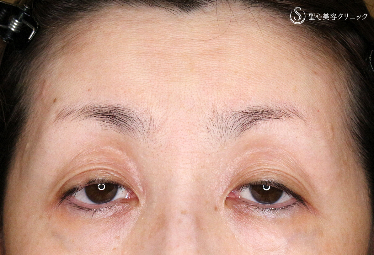 切らない眼瞼下垂+α法（札幌院独自メニュー）_Before