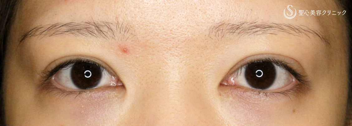 目頭切開+α法（札幌院独自メニュー）＋二重全切開+α法（札幌院独自メニュー）_After