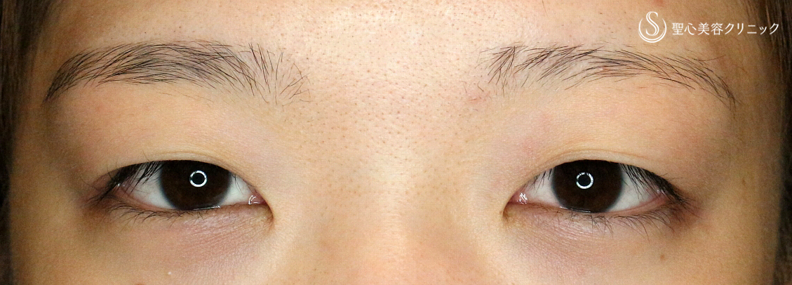 目頭切開+α法（札幌院独自メニュー）＋二重全切開+α法（札幌院独自メニュー）_Before