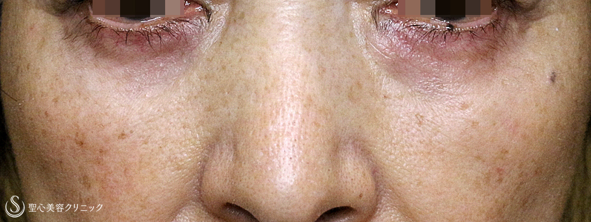 表ハムラ+α法（札幌院独自メニュー）＋プレミアムPRP皮膚再生療法（目元のくぼみ・たるみ）_After