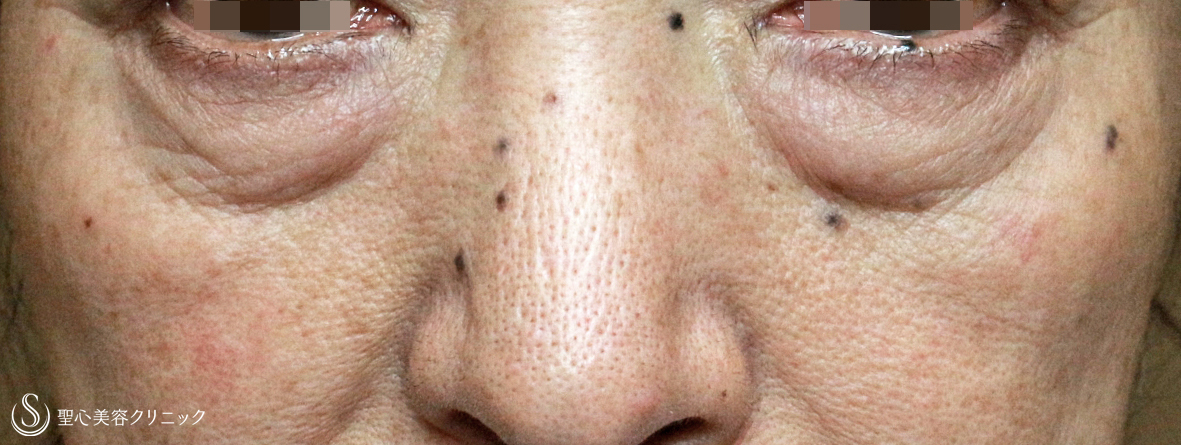 表ハムラ+α法（札幌院独自メニュー）＋プレミアムPRP皮膚再生療法（目元のくぼみ・たるみ）_Before