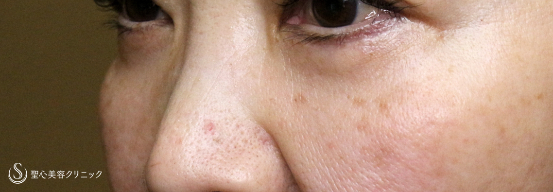 表ハムラ+α法（札幌院独自メニュー）_After