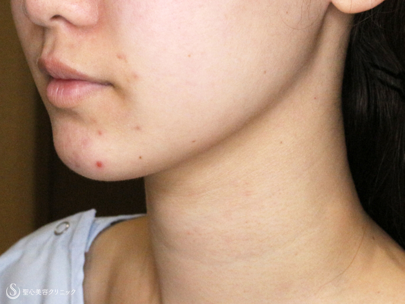  ベイザーリポ2.2脂肪吸引_After