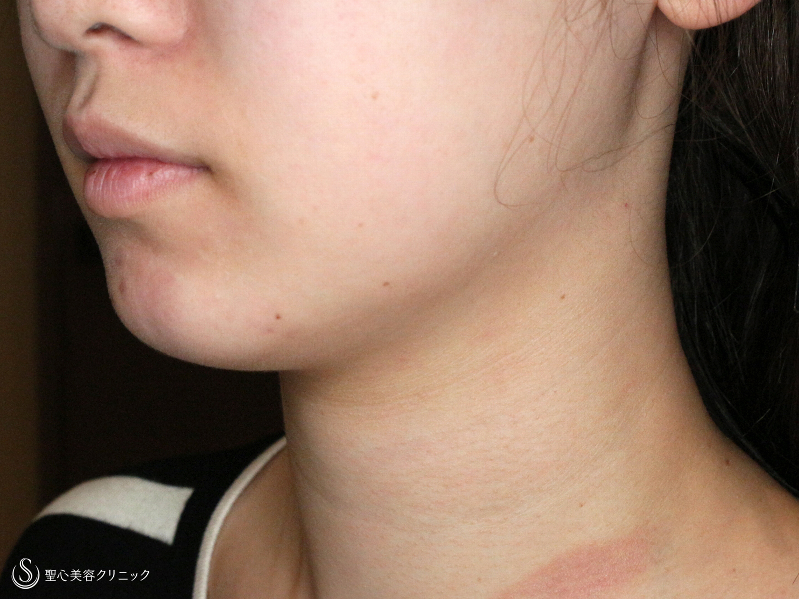 ベイザーリポ2.2脂肪吸引_Before