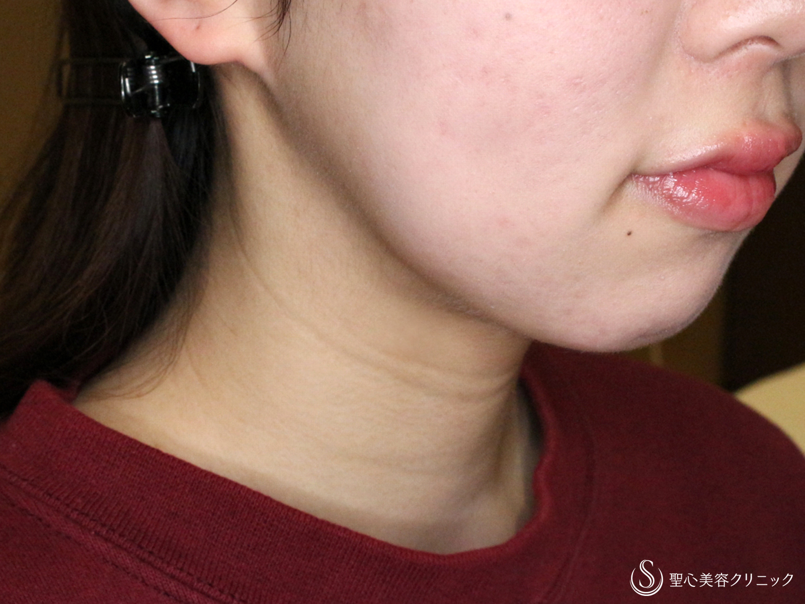 脂肪吸引注射_After