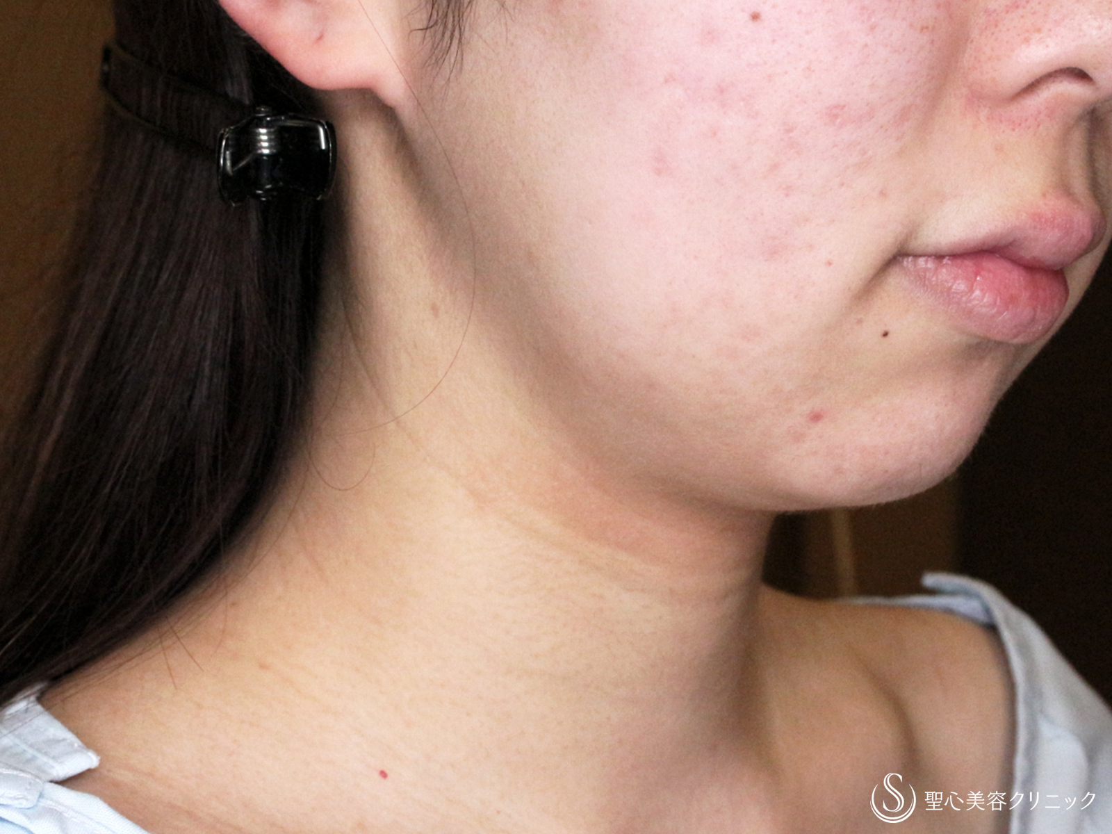 脂肪吸引注射_Before